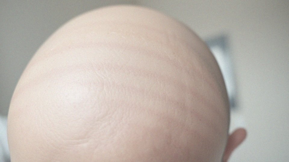 Jakie są przyczyny pomarszczonej skóry na głowie?